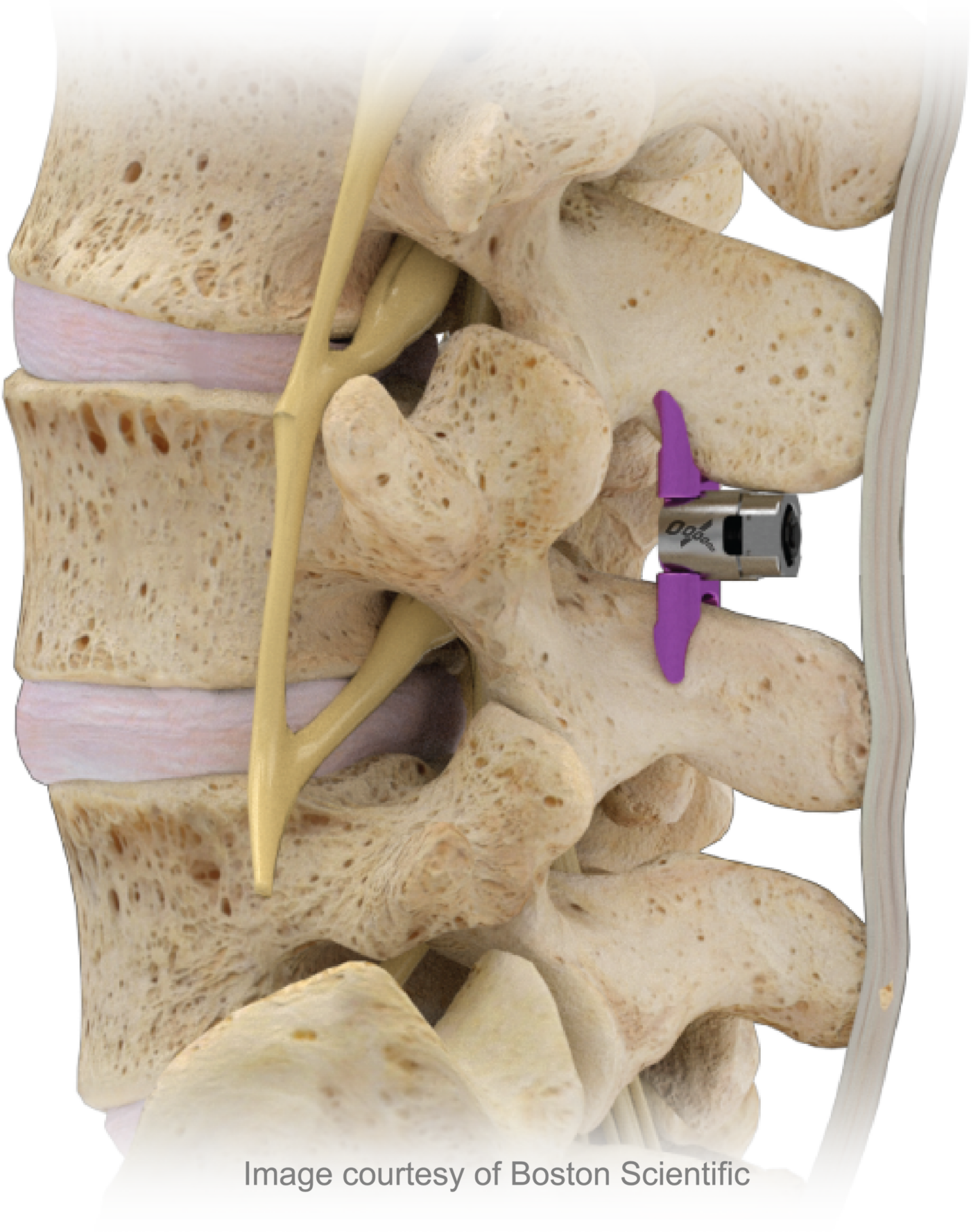 Vertiflex Procedure - Physicians Pain Services